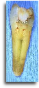 Tooth Dental implant uk