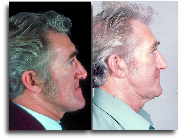 Jaw Surgery Orthognathic 2