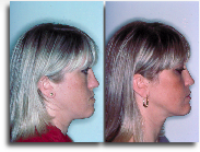 Jaw Surgery Orthognathic 1