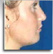 Chin implant 2