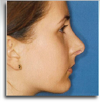 Rhinoplasty after