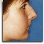 Rhinoplasty before