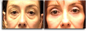 Belpharoplasty before and after