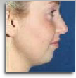 Chin implant 1